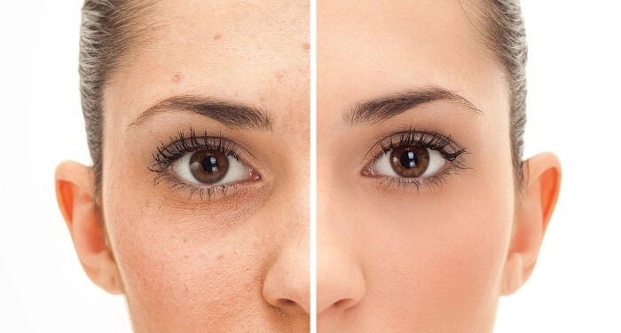 Can Fractional CO2 Laser Treat Pigmentation and Dark Spots