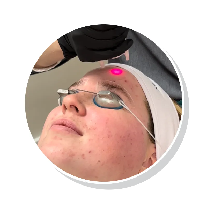 Best Microneedling In Plainview
